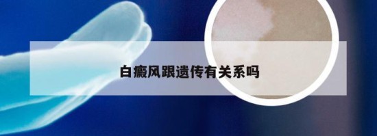 白癜風(fēng)跟遺傳有關(guān)系嗎